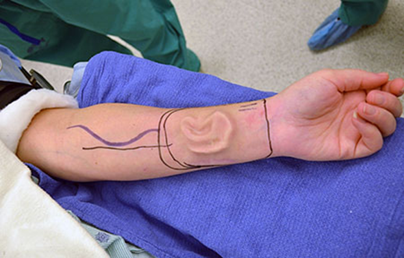 Ear grown on arm